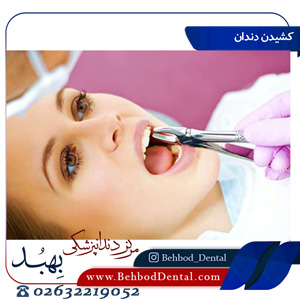 کشیدن دندان