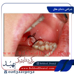 جراحی-دندان-عقل
