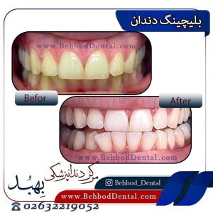 بلیچینگ دندان
