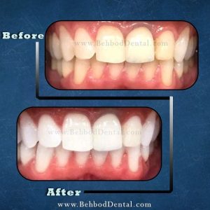 نمونه بلیچینگ دندان کلینیک بهبد