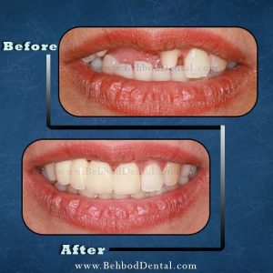 نمونه پروتز دندان کلینیک دندانپزشکی بهبد