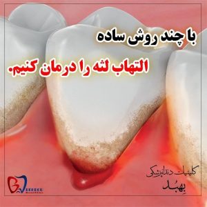 درمان التهاب لثه