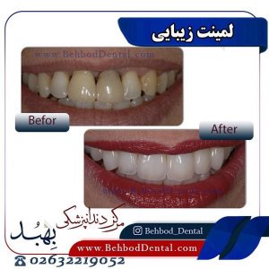 نمونه لمینت زیبایی دندانپزشکی بهبد