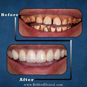 نمونه ونیر کامپوزیت دندانپزشکی بهبد